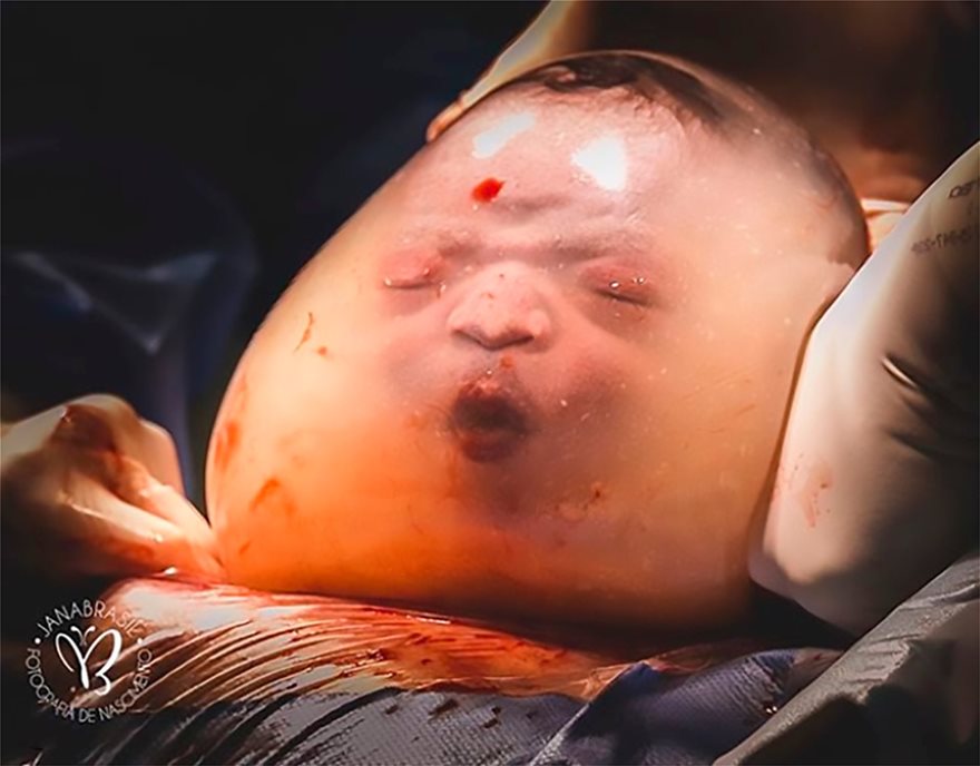 Φωτογραφίες-σοκ: Μωρό γεννήθηκε μέσα στον αμνιακό σάκο - Φωτογραφία 5