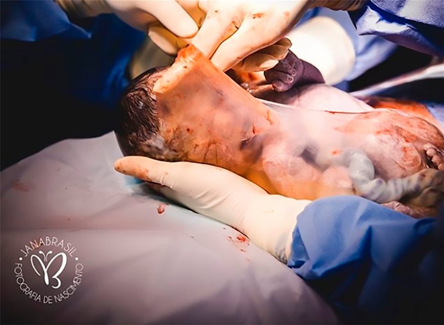 Φωτογραφίες-σοκ: Μωρό γεννήθηκε μέσα στον αμνιακό σάκο - Φωτογραφία 7