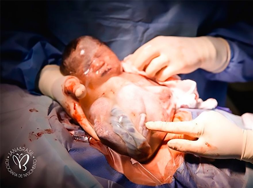 Φωτογραφίες-σοκ: Μωρό γεννήθηκε μέσα στον αμνιακό σάκο - Φωτογραφία 8
