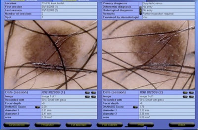Τι είναι η ψηφιακή χαρτογράφηση σπίλων, για τις ελιές του δέρματος, τον καρκίνο, το μελάνωμα - Φωτογραφία 6