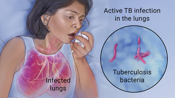 Η φυματίωση ξαναείναι εδώ, με περίπου 600 νέα περιστατικά τον χρόνο. Η φυματίωση βρίσκεται σε παγκόσμια έξαρση - Φωτογραφία 1