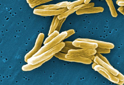 Η φυματίωση ξαναείναι εδώ, με περίπου 600 νέα περιστατικά τον χρόνο. Η φυματίωση βρίσκεται σε παγκόσμια έξαρση - Φωτογραφία 3
