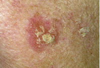 Τα προειδοποιητικά σημάδια του καρκίνου του δέρματος (φωτο) - Φωτογραφία 2