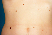 Τα προειδοποιητικά σημάδια του καρκίνου του δέρματος (φωτο) - Φωτογραφία 6