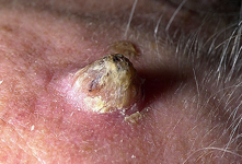 Τα προειδοποιητικά σημάδια του καρκίνου του δέρματος (φωτο) - Φωτογραφία 4