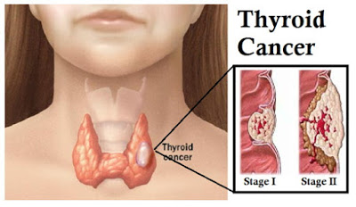 Καλπάζει ο καρκίνος του Θυρεοειδούς. Συμπτώματα και αιτίες που εκδηλώνει καρκίνο ο θυρεοειδής - Φωτογραφία 3