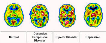 Διπολική διαταραχή, μανιοκατάθλιψη. κυκλοθυμία με μεταπτώσεις διάθεσης, κυκλοθυμία, μανία, κατάθλιψη - Φωτογραφία 5