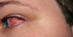 Computer Vision Syndrome από πολύωρη χρήση στον υπολογιστή με πονοκέφαλο, ξηροφθαλμία, θολή όραση, κουρασμένα μάτια, πόνος στον αυχένα - Φωτογραφία 3