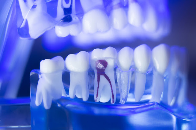 Τι θα συμβεί αν αμελήσετε μια τρύπα στο δόντι; [εικόνες] - Φωτογραφία 3