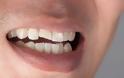 Τι θα συμβεί αν αμελήσετε μια τρύπα στο δόντι; [εικόνες] - Φωτογραφία 2