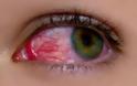 Ραγοειδίτιδα: Τα αίτια και τα συμπτώματα της άγνωστης πάθησης που «απειλεί» την όραση!