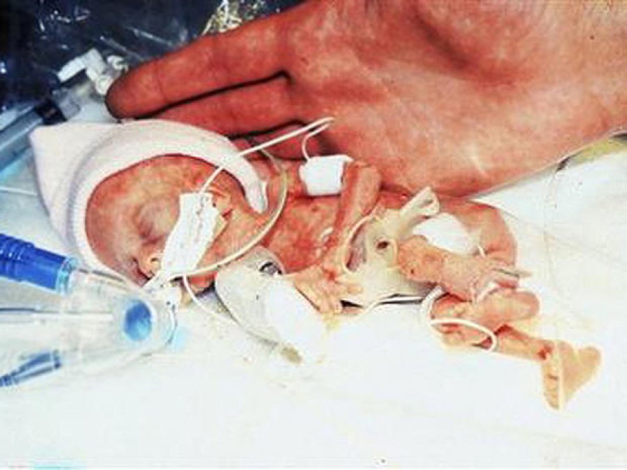 Δείτε πώς είναι σήμερα το μικρότερο μωρό του κόσμου που ζύγιζε 280 γραμμάρια - Φωτογραφία 1
