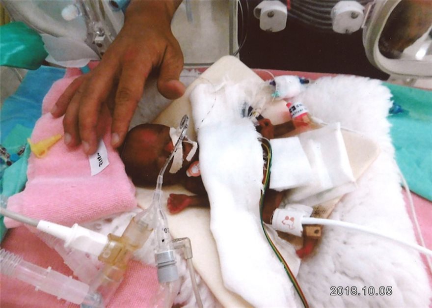 Ιαπωνία: Εξιτήριο από το νοσοκομείο πήρε το μικρότερο μωρό του κόσμου - Φωτογραφία 2