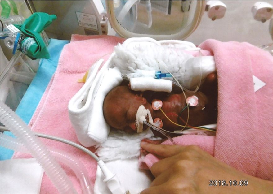 Ιαπωνία: Εξιτήριο από το νοσοκομείο πήρε το μικρότερο μωρό του κόσμου - Φωτογραφία 3
