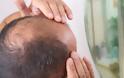 Οι δερματολόγοι κρούουν τον κώδωνα του κινδύνου για τις μεταμοσχεύσεις μαλλιών χαμηλού κόστους - Φωτογραφία 2
