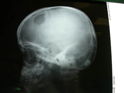 Η συγκινητική ιστορία με το παιδάκι από τον πόλεμο στο Ιράκ και τη σφαίρα στον εγκέφαλο - Φωτογραφία 3
