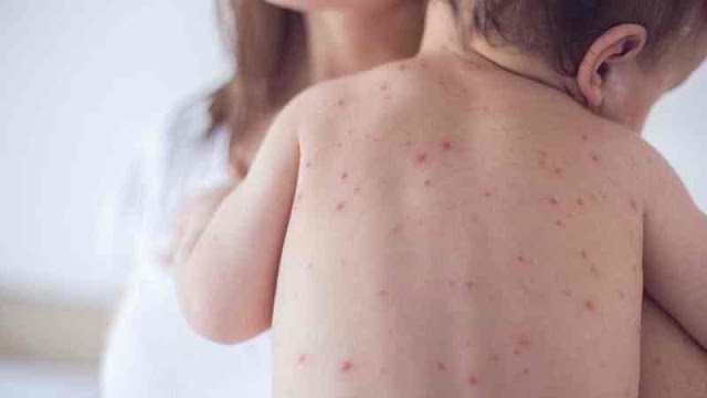 Παγκόσμιος συναγερμός για την αύξηση των περιστατικών ιλαράς λόγω της άρνησης εμβολιασμού των παιδιών - Φωτογραφία 2