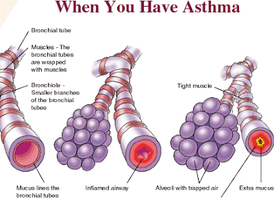 Άσθμα, μια σύγχρονη επιδημία. Παγκόσμια Ημέρα Άσθματος - Φωτογραφία 5
