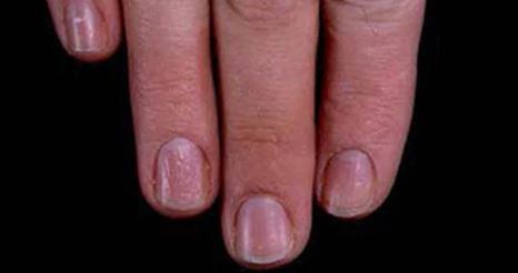 Τα πέντε προβλήματα υγείας που μπορούν να εκδηλωθούν στα νύχια - Φωτογραφία 2