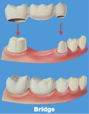 Γιατί χάνεται ένα δόντι; Απώλεια δοντιού, αιτία, συνέπειες, πρόληψη, αντιμετώπιση - Φωτογραφία 11