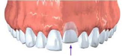 Γιατί χάνεται ένα δόντι; Απώλεια δοντιού, αιτία, συνέπειες, πρόληψη, αντιμετώπιση - Φωτογραφία 4