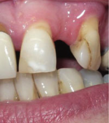 Γιατί χάνεται ένα δόντι; Απώλεια δοντιού, αιτία, συνέπειες, πρόληψη, αντιμετώπιση - Φωτογραφία 5