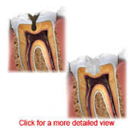 Γιατί χάνεται ένα δόντι; Απώλεια δοντιού, αιτία, συνέπειες, πρόληψη, αντιμετώπιση - Φωτογραφία 8