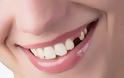 Γιατί χάνεται ένα δόντι; Απώλεια δοντιού, αιτία, συνέπειες, πρόληψη, αντιμετώπιση - Φωτογραφία 1