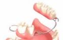 Γιατί χάνεται ένα δόντι; Απώλεια δοντιού, αιτία, συνέπειες, πρόληψη, αντιμετώπιση - Φωτογραφία 12