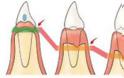 Γιατί χάνεται ένα δόντι; Απώλεια δοντιού, αιτία, συνέπειες, πρόληψη, αντιμετώπιση - Φωτογραφία 3