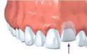 Γιατί χάνεται ένα δόντι; Απώλεια δοντιού, αιτία, συνέπειες, πρόληψη, αντιμετώπιση - Φωτογραφία 4