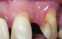 Γιατί χάνεται ένα δόντι; Απώλεια δοντιού, αιτία, συνέπειες, πρόληψη, αντιμετώπιση - Φωτογραφία 5