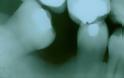 Γιατί χάνεται ένα δόντι; Απώλεια δοντιού, αιτία, συνέπειες, πρόληψη, αντιμετώπιση - Φωτογραφία 6