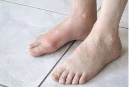 18 προβλήματα των ποδιών μας που μας προειδοποιούν για τη συνολική μας υγεία - Φωτογραφία 11