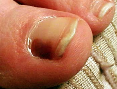 Μελάνωμα σε νύχι, άκρες δακτύλων. Οι σκούρες γραμμές στα νύχια είναι αιμάτωμα ή καρκίνος; - Φωτογραφία 11