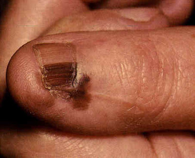 Μελάνωμα σε νύχι, άκρες δακτύλων. Οι σκούρες γραμμές στα νύχια είναι αιμάτωμα ή καρκίνος; - Φωτογραφία 12