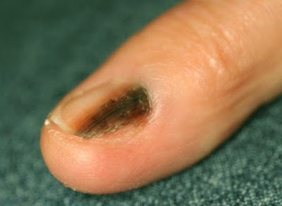 Μελάνωμα σε νύχι, άκρες δακτύλων. Οι σκούρες γραμμές στα νύχια είναι αιμάτωμα ή καρκίνος; - Φωτογραφία 13