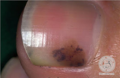 Μελάνωμα σε νύχι, άκρες δακτύλων. Οι σκούρες γραμμές στα νύχια είναι αιμάτωμα ή καρκίνος; - Φωτογραφία 3