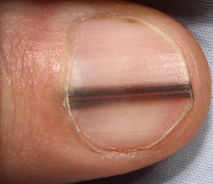 Μελάνωμα σε νύχι, άκρες δακτύλων. Οι σκούρες γραμμές στα νύχια είναι αιμάτωμα ή καρκίνος; - Φωτογραφία 6