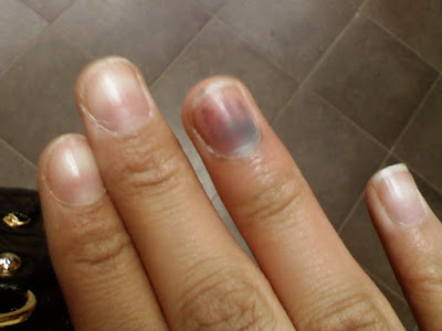 Μελάνωμα σε νύχι, άκρες δακτύλων. Οι σκούρες γραμμές στα νύχια είναι αιμάτωμα ή καρκίνος; - Φωτογραφία 8