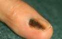 Μελάνωμα σε νύχι, άκρες δακτύλων. Οι σκούρες γραμμές στα νύχια είναι αιμάτωμα ή καρκίνος;