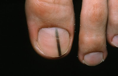 Μελάνωμα σε νύχι, άκρες δακτύλων. Οι σκούρες γραμμές στα νύχια είναι αιμάτωμα ή καρκίνος; - Φωτογραφία 7