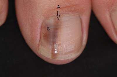 Μελάνωμα σε νύχι, άκρες δακτύλων. Οι σκούρες γραμμές στα νύχια είναι αιμάτωμα ή καρκίνος; - Φωτογραφία 9