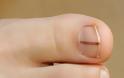 Μελάνωμα σε νύχι, άκρες δακτύλων. Οι σκούρες γραμμές στα νύχια είναι αιμάτωμα ή καρκίνος; - Φωτογραφία 5