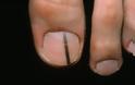 Μελάνωμα σε νύχι, άκρες δακτύλων. Οι σκούρες γραμμές στα νύχια είναι αιμάτωμα ή καρκίνος; - Φωτογραφία 7