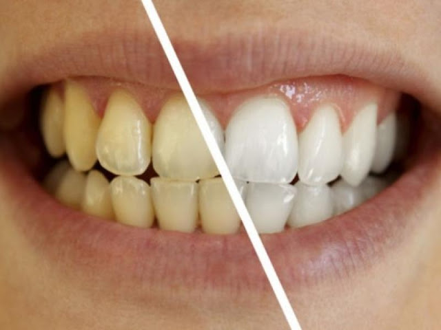 Τι μπορεί να προκαλέσει αλλαγή στο χρώμα των δοντιών μας; - Φωτογραφία 1