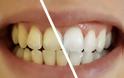 Τι μπορεί να προκαλέσει αλλαγή στο χρώμα των δοντιών μας; - Φωτογραφία 1