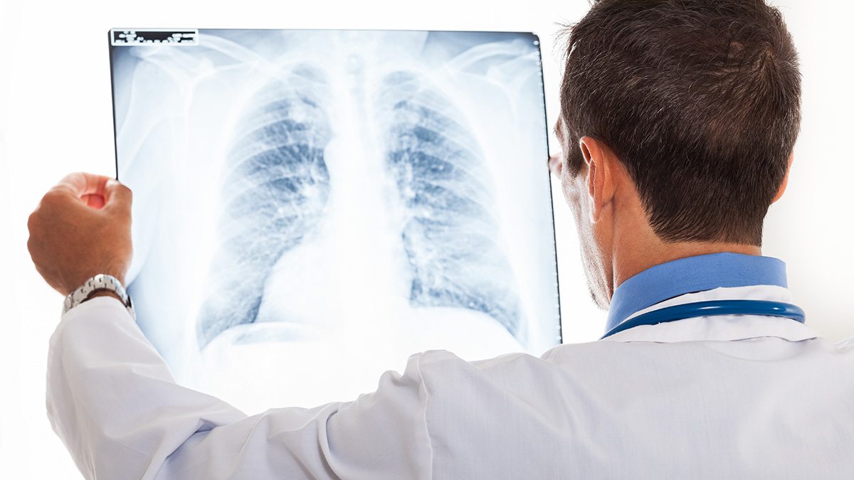 Καρκίνος Πνεύμονα: Η Ανοσοθεραπεία χαρίζει χρόνο ζωής στους ασθενείς - Φωτογραφία 1