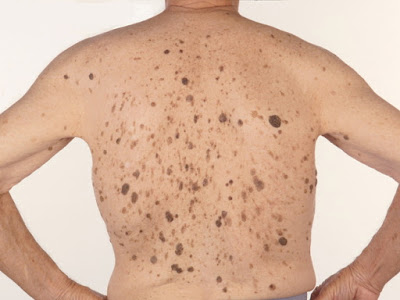 Σμηγματορροϊκή υπερκεράτωση, στο δέρμα. Πόσο επικίνδυνη είναι και πώς αφαιρείται; - Φωτογραφία 1