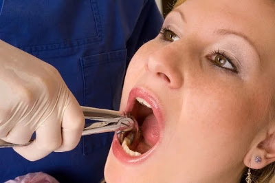 Ξηρό φατνίο. Μία δυσάρεστη μετεγχειρητική οδοντιατρική επιπλοκή - Φωτογραφία 1
